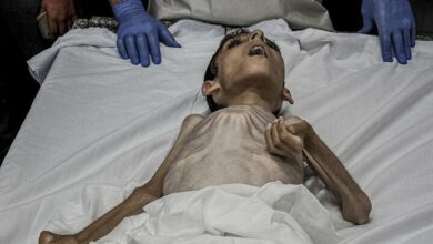 Another Palestinian child died as a result of malnutrition