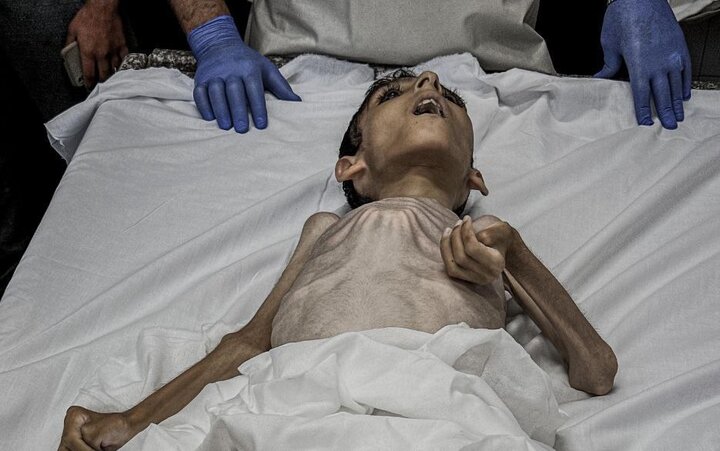 Another Palestinian child died as a result of malnutrition