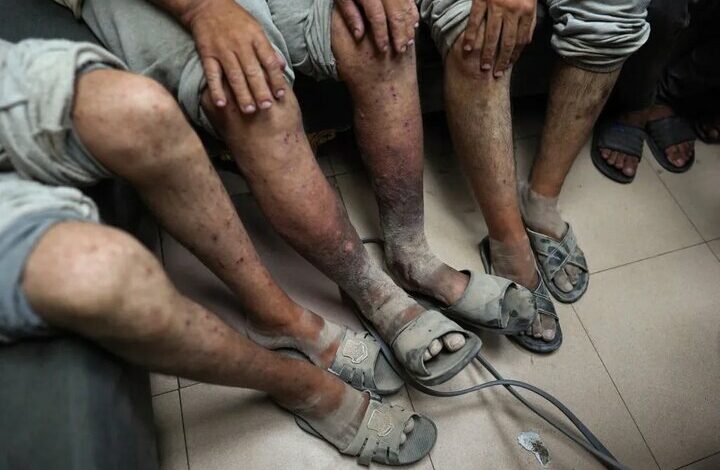 The effects of torture and malnutrition on the bodies of prisoners released from Israeli prisons