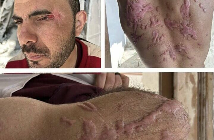 Works of Zionist brutal torture on the body of the released Palestinian+ Movie